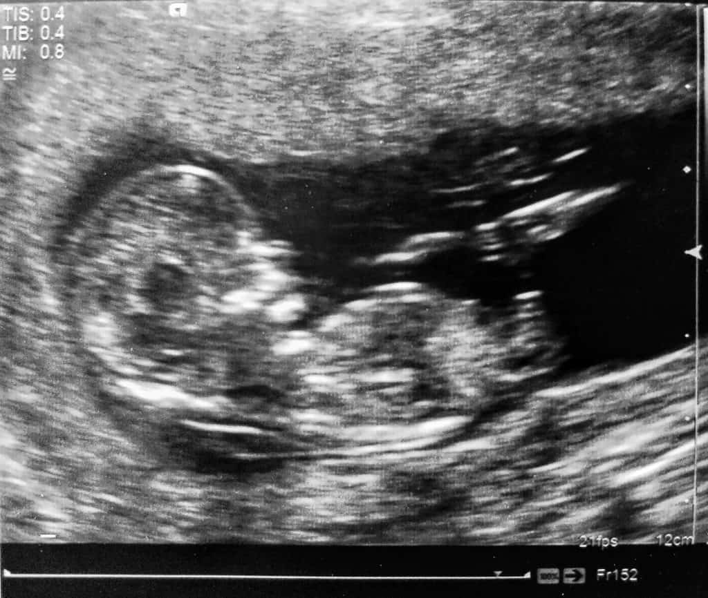 Twenty-Week Scan